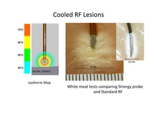 Cooled RF Lesions
SACRAL SURFACE
Isotherm Map
White meat tests comparing SInergy probe
and Standard RF
10 mm
3.5 mm
 