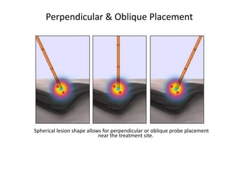 Perpendicular & Oblique Placement
Spherical lesion shape allows for perpendicular or oblique probe placement
near the treatment site.
 