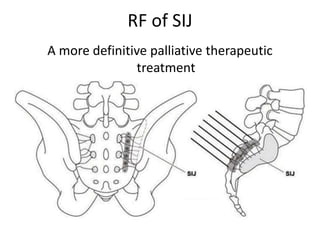RF of SIJ
A more definitive palliative therapeutic
treatment
 