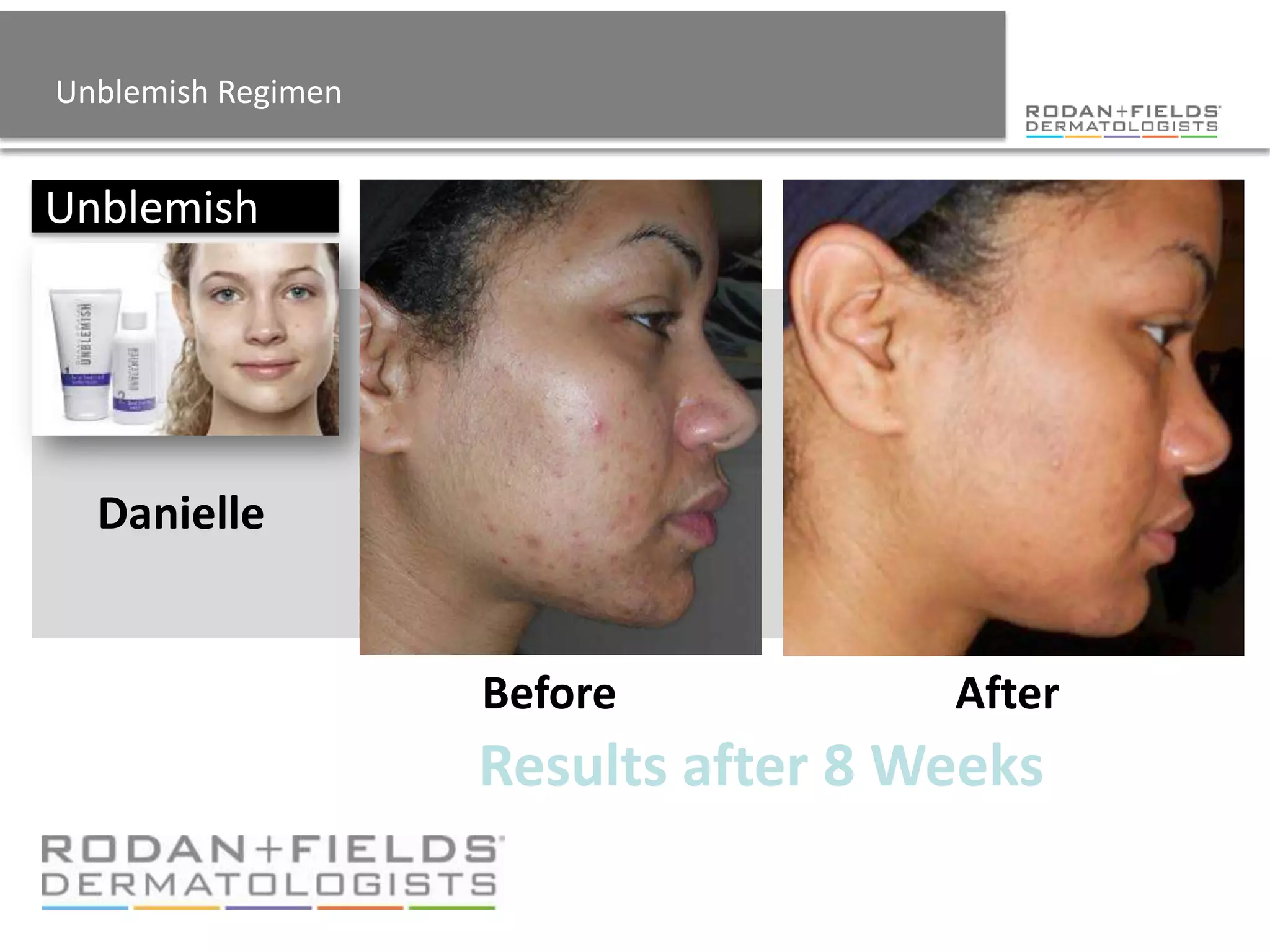 Unblemish Regimen


Unblemish




  Danielle


                    Before           After
                    Results after 8 Weeks
 