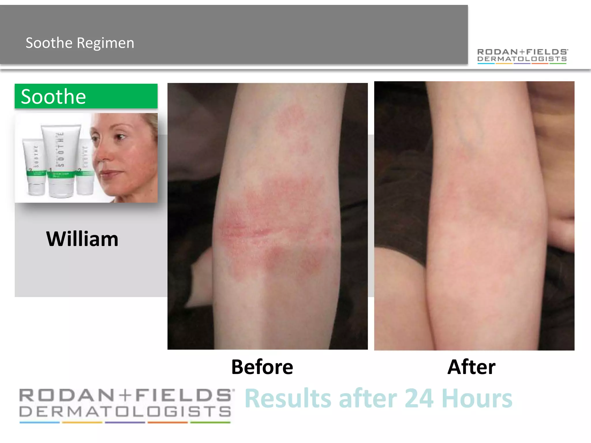 Soothe Regimen


Soothe




  William




                 Before           After
                  Results after 24 Hours
 