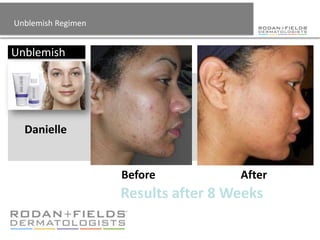 Unblemish Regimen


Unblemish




  Danielle


                    Before           After
                    Results after 8 Weeks
 