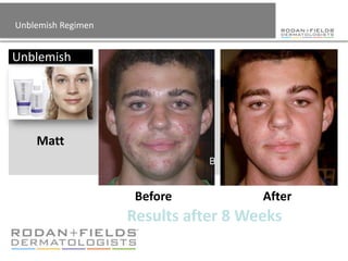 Unblemish Regimen


Unblemish




    Matt



                     Before           After
                    Results after 8 Weeks
 