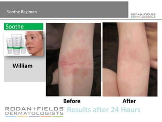 Soothe Regimen


Soothe




  William




                 Before           After
                  Results after 24 Hours
 