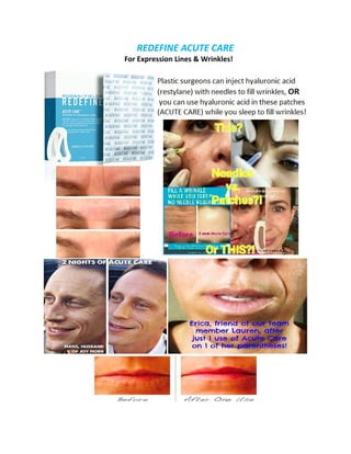 REDEFINE ACUTE CARE
For Expression Lines & Wrinkles!
 