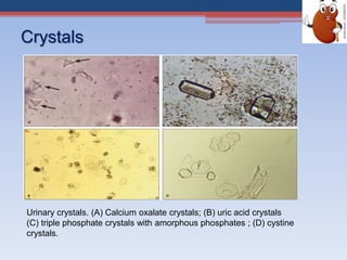 Crystals
Urinary crystals. (A) Calcium oxalate crystals; (B) uric acid crystals
(C) triple phosphate crystals with amorphous phosphates ; (D) cystine
crystals.
 