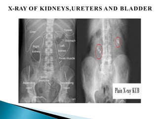 X-RAY OF KIDNEYS,URETERS AND BLADDER
 