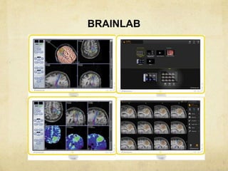 Stereotactic radiosurgery and radiotherapy | PPTX