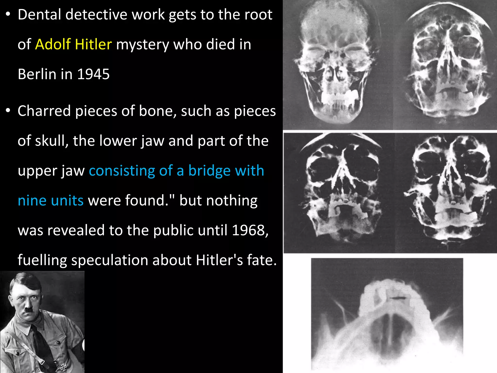 • Dental detective work gets to the root
of Adolf Hitler mystery who died in
Berlin in 1945
• Charred pieces of bone, such as pieces
of skull, the lower jaw and part of the
upper jaw consisting of a bridge with
nine units were found." but nothing
was revealed to the public until 1968,
fuelling speculation about Hitler's fate.
 