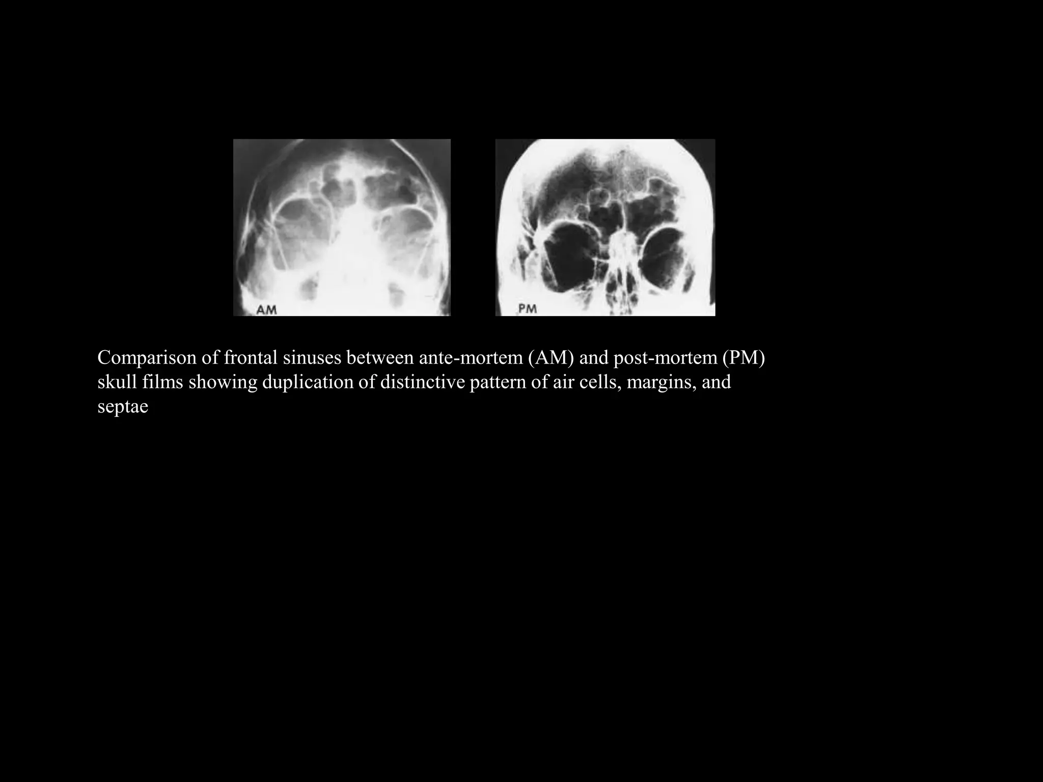 Comparison of frontal sinuses between ante-mortem (AM) and post-mortem (PM)
skull films showing duplication of distinctive pattern of air cells, margins, and
septae
 