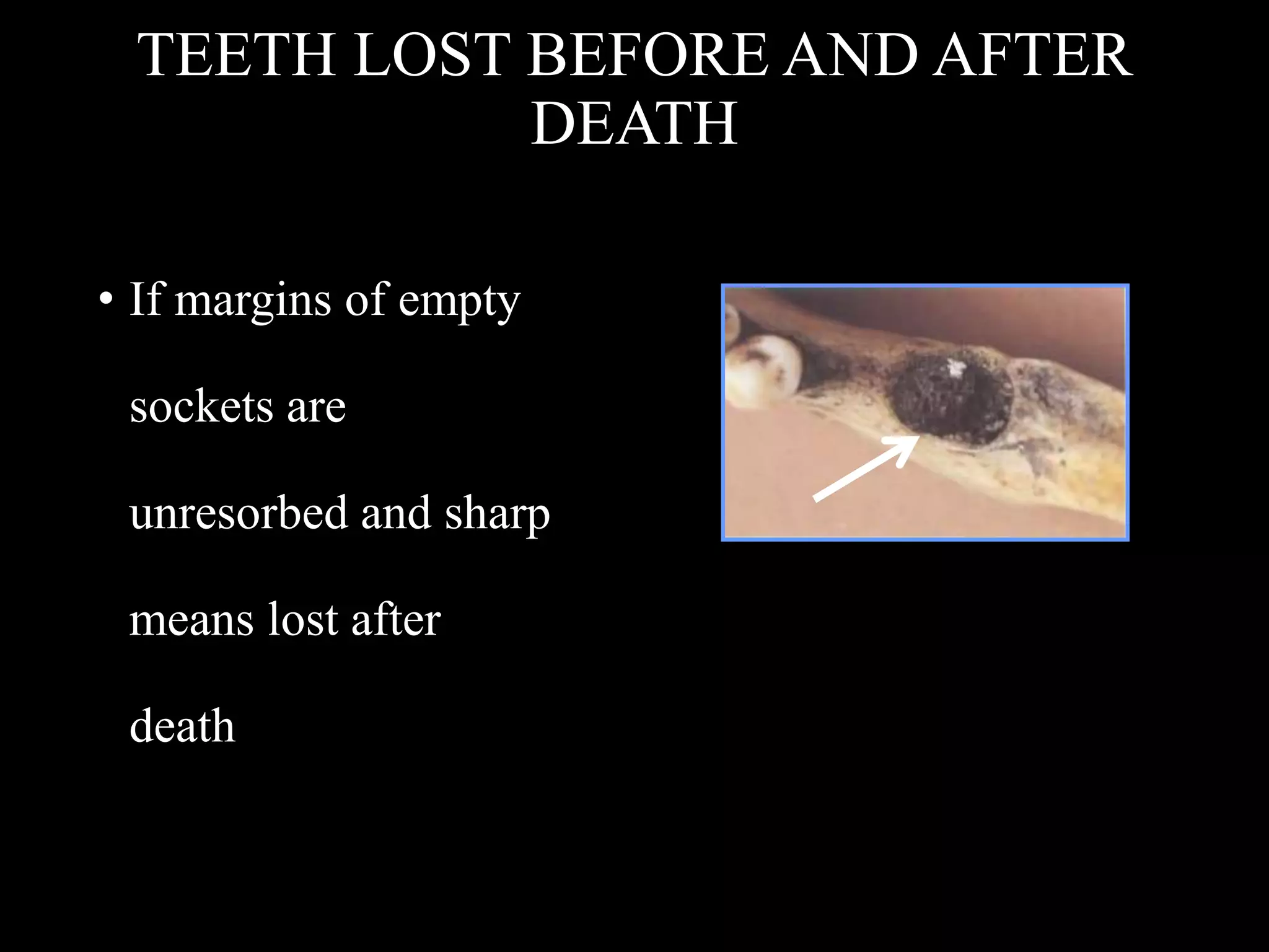 TEETH LOST BEFORE AND AFTER
DEATH
• If margins of empty
sockets are
unresorbed and sharp
means lost after
death
 