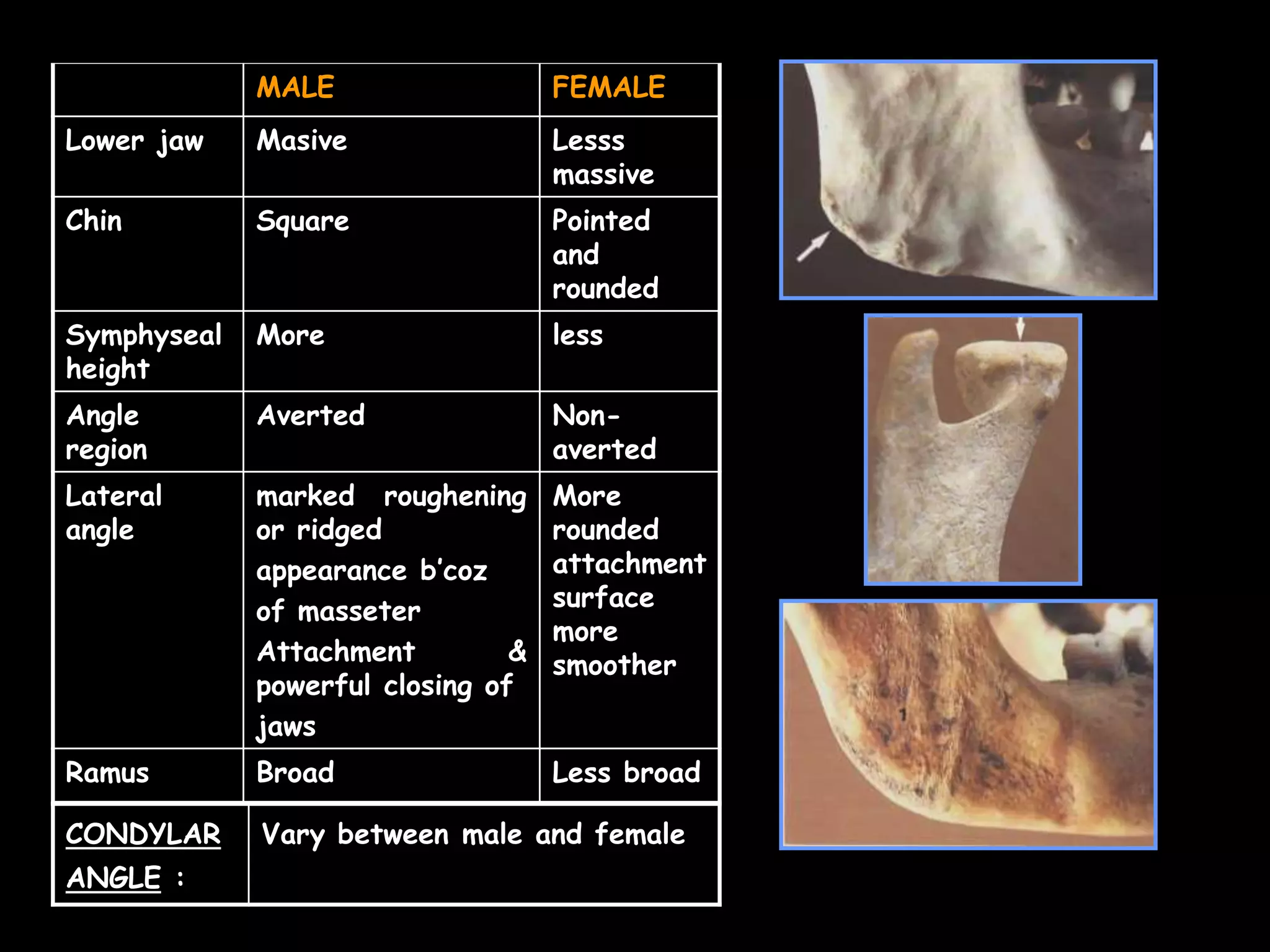 MALE FEMALE
Lower jaw Masive Lesss
massive
Chin Square Pointed
and
rounded
Symphyseal
height
More less
Angle
region
Averted Non-
averted
Lateral
angle
marked roughening
or ridged
appearance b’coz
of masseter
Attachment &
powerful closing of
jaws
More
rounded
attachment
surface
more
smoother
Ramus Broad Less broad
CONDYLAR
ANGLE :
Vary between male and female
 