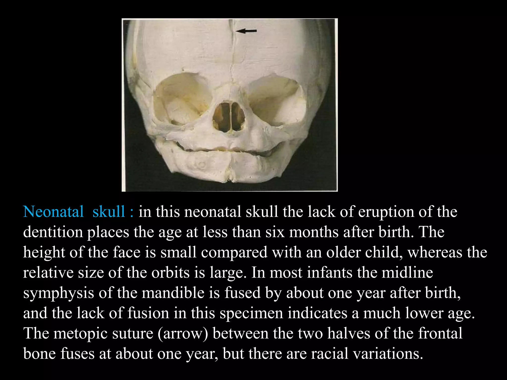 Neonatal skull : in this neonatal skull the lack of eruption of the
dentition places the age at less than six months after birth. The
height of the face is small compared with an older child, whereas the
relative size of the orbits is large. In most infants the midline
symphysis of the mandible is fused by about one year after birth,
and the lack of fusion in this specimen indicates a much lower age.
The metopic suture (arrow) between the two halves of the frontal
bone fuses at about one year, but there are racial variations.
 