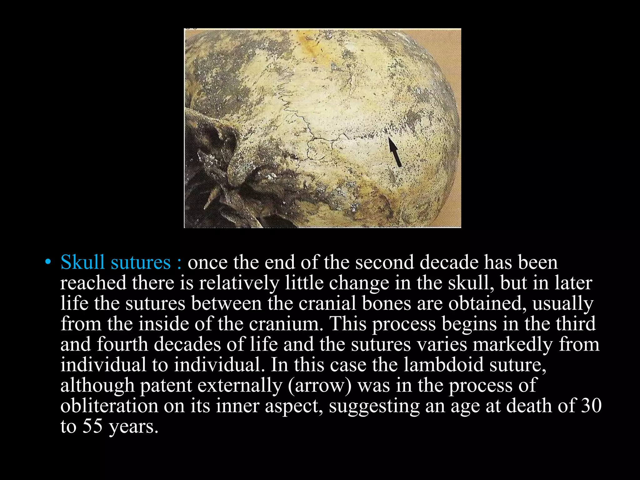 • Skull sutures : once the end of the second decade has been
reached there is relatively little change in the skull, but in later
life the sutures between the cranial bones are obtained, usually
from the inside of the cranium. This process begins in the third
and fourth decades of life and the sutures varies markedly from
individual to individual. In this case the lambdoid suture,
although patent externally (arrow) was in the process of
obliteration on its inner aspect, suggesting an age at death of 30
to 55 years.
 