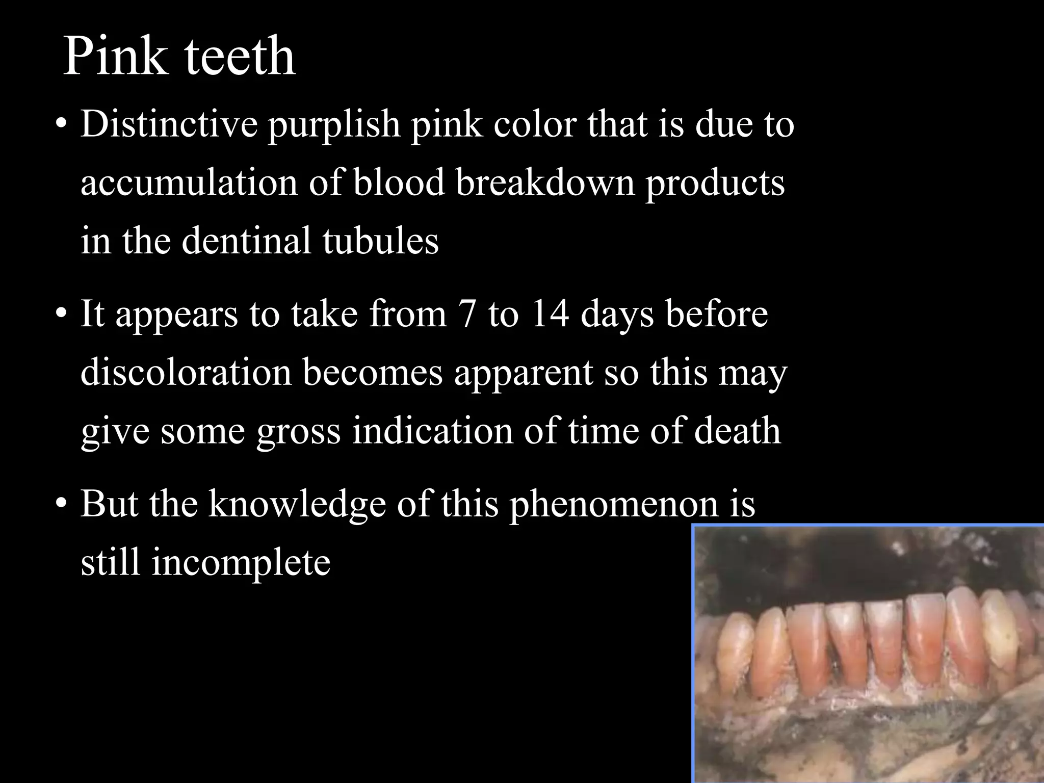 Pink teeth
• Distinctive purplish pink color that is due to
accumulation of blood breakdown products
in the dentinal tubules
• It appears to take from 7 to 14 days before
discoloration becomes apparent so this may
give some gross indication of time of death
• But the knowledge of this phenomenon is
still incomplete
 