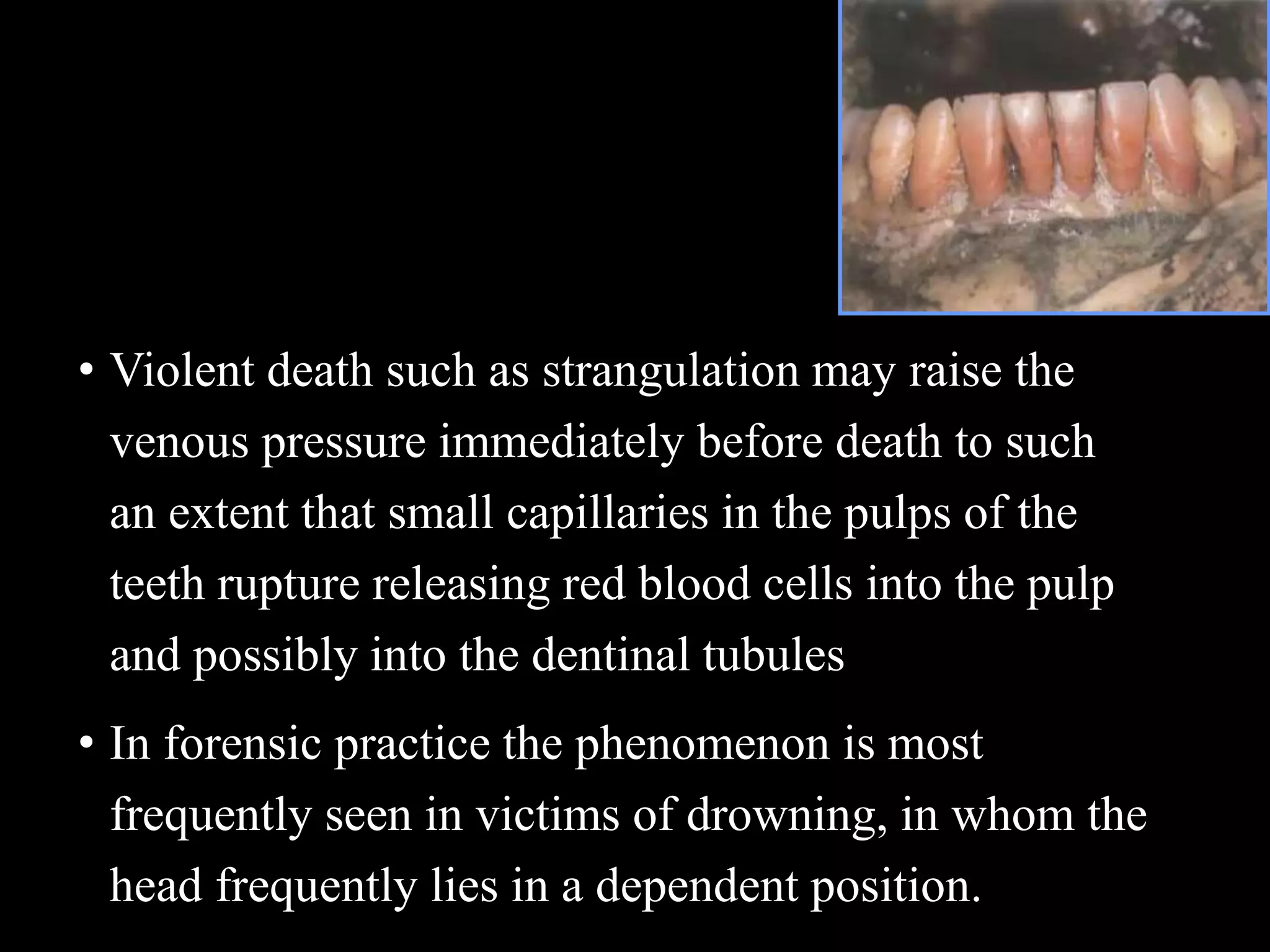 • Violent death such as strangulation may raise the
venous pressure immediately before death to such
an extent that small capillaries in the pulps of the
teeth rupture releasing red blood cells into the pulp
and possibly into the dentinal tubules
• In forensic practice the phenomenon is most
frequently seen in victims of drowning, in whom the
head frequently lies in a dependent position.
 