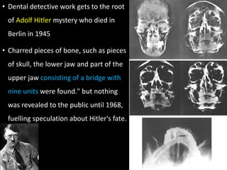 • Dental detective work gets to the root
of Adolf Hitler mystery who died in
Berlin in 1945
• Charred pieces of bone, such as pieces
of skull, the lower jaw and part of the
upper jaw consisting of a bridge with
nine units were found." but nothing
was revealed to the public until 1968,
fuelling speculation about Hitler's fate.
 