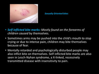 • Self inflicted bite marks: Mostly found on the forearms of
children caused by themselves.
• Sometimes arms may be pushed into the child's mouth to stop
crying or due to intense pain, children may bite themselves
because of fear.
• Mentally retarded and psychologically disturbed people may
also inflict bite on themselves. Self inflicted bite marks are also
seen in Lesch-Nyhan syndrome, a X-linked, recessively
transmitted disease with insensitivity to pain.
Sexually Oriented bites
 