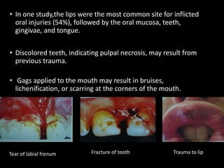 • In one study,the lips were the most common site for inflicted
oral injuries (54%), followed by the oral mucosa, teeth,
gingivae, and tongue.
• Discolored teeth, indicating pulpal necrosis, may result from
previous trauma.
• Gags applied to the mouth may result in bruises,
lichenification, or scarring at the corners of the mouth.
•
Tear of labial frenum Trauma to lipFracture of tooth
 