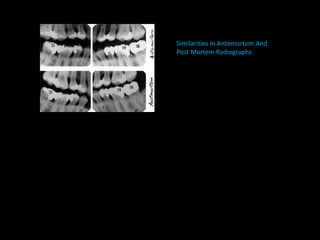 Similarities In Antemortem And
Post Mortem Radiographs
 