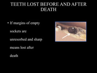 TEETH LOST BEFORE AND AFTER
DEATH
• If margins of empty
sockets are
unresorbed and sharp
means lost after
death
 