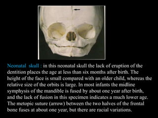 Neonatal skull : in this neonatal skull the lack of eruption of the
dentition places the age at less than six months after birth. The
height of the face is small compared with an older child, whereas the
relative size of the orbits is large. In most infants the midline
symphysis of the mandible is fused by about one year after birth,
and the lack of fusion in this specimen indicates a much lower age.
The metopic suture (arrow) between the two halves of the frontal
bone fuses at about one year, but there are racial variations.
 