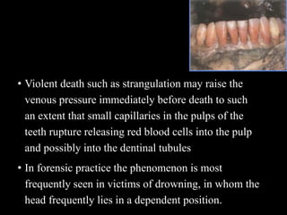 • Violent death such as strangulation may raise the
venous pressure immediately before death to such
an extent that small capillaries in the pulps of the
teeth rupture releasing red blood cells into the pulp
and possibly into the dentinal tubules
• In forensic practice the phenomenon is most
frequently seen in victims of drowning, in whom the
head frequently lies in a dependent position.
 