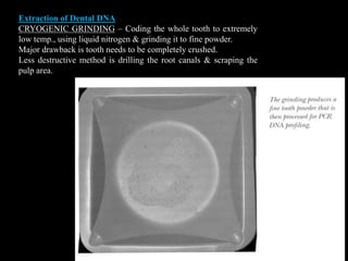 Extraction of Dental DNA
CRYOGENIC GRINDING – Coding the whole tooth to extremely
low temp., using liquid nitrogen & grinding it to fine powder.
Major drawback is tooth needs to be completely crushed.
Less destructive method is drilling the root canals & scraping the
pulp area.
 