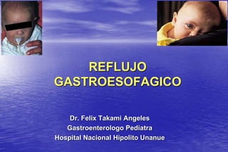 REFLUJO  GASTROESOFAGICO Dr. Felix Takami Angeles Gastroenterologo Pediatra Hospital Nacional Hipolito Unanue  