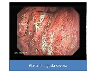 Gastritis aguda severa
 
