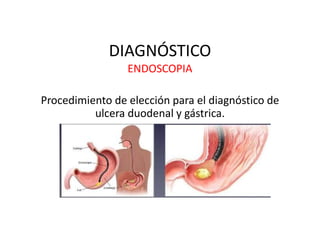 DIAGNÓSTICO
ENDOSCOPIA
Procedimiento de elección para el diagnóstico de
ulcera duodenal y gástrica.
 