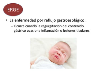 • La enfermedad por reflujo gastroesofágico :
– Ocurre cuando la regurgitación del contenido
gástrico ocasiona inflamación o lesiones tisulares.
ERGE
 
