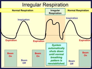 Irregular Respiration System automatically shuts down until normal breathing pattern is reestablished. Beam On Beam On Beam Off Normal Respiration Normal Respiration Beam Off Inspiration Expiration Inspiration Expiration Expiration Beam On Irregular Respiration 
