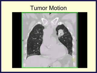 Tumor Motion 