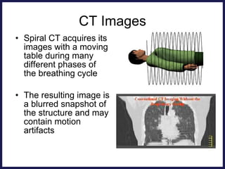 CT Images Spiral CT acquires its images with a moving table during many different phases of the breathing cycle The resulting image is a blurred snapshot of the structure and may contain motion artifacts 