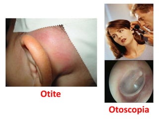 Otite
Otoscopia
 