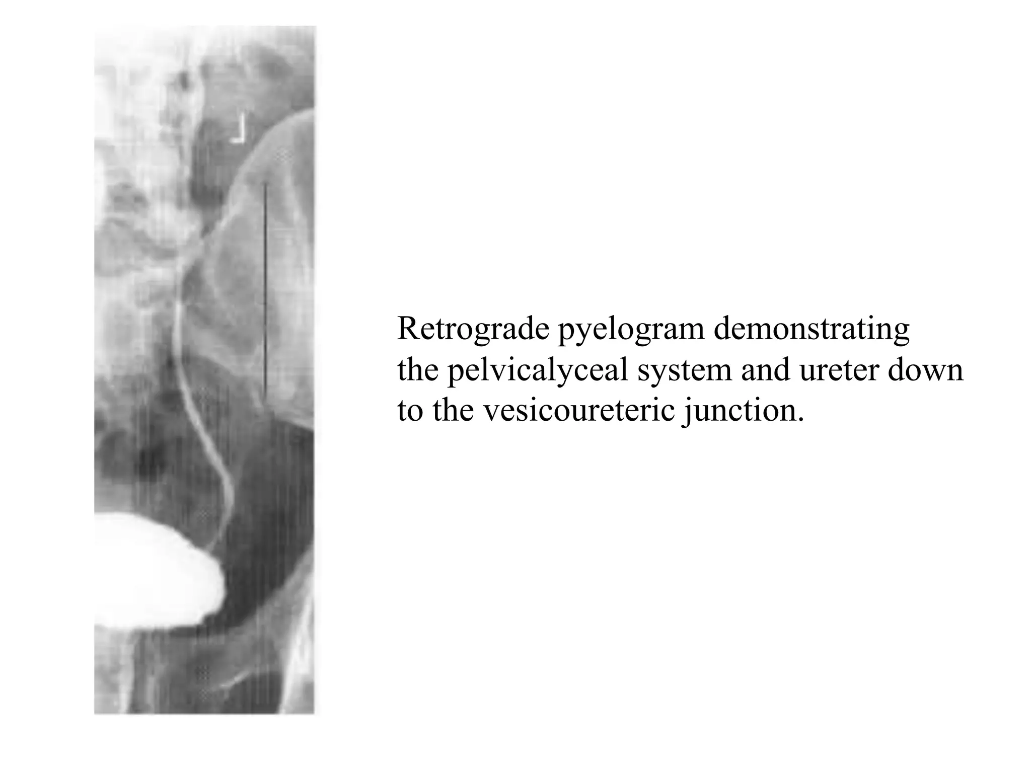 Retrograde Pyelography