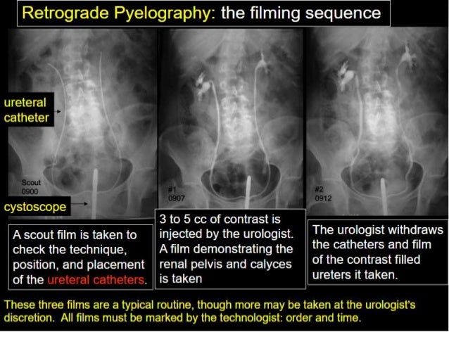 Retrograde Pyelography Retrograde Pyelography