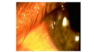 Truncated Rgp RGP Complications and Management.pptx