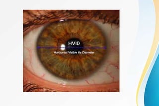Procornea Rgp Rgp lens | PPTX