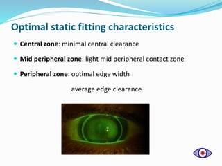 Optimal static fitting characteristics
 Central zone: minimal central clearance
 Mid peripheral zone: light mid peripheral contact zone
 Peripheral zone: optimal edge width
average edge clearance
 