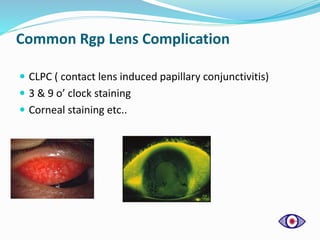 Common Rgp Lens Complication
 CLPC ( contact lens induced papillary conjunctivitis)
 3 & 9 o’ clock staining
 Corneal staining etc..
 