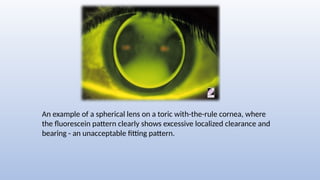 An example of a spherical lens on a toric with-the-rule cornea, where
the fluorescein pattern clearly shows excessive localized clearance and
bearing - an unacceptable fitting pattern.
 