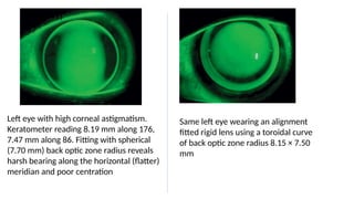 Left eye with high corneal astigmatism.
Keratometer reading 8.19 mm along 176,
7.47 mm along 86. Fitting with spherical
(7.70 mm) back optic zone radius reveals
harsh bearing along the horizontal (flatter)
meridian and poor centration
Same left eye wearing an alignment
fitted rigid lens using a toroidal curve
of back optic zone radius 8.15 × 7.50
mm
 