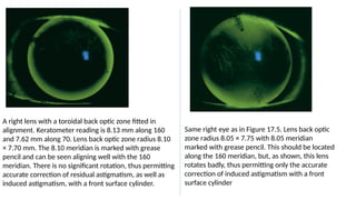 A right lens with a toroidal back optic zone fitted in
alignment. Keratometer reading is 8.13 mm along 160
and 7.62 mm along 70. Lens back optic zone radius 8.10
× 7.70 mm. The 8.10 meridian is marked with grease
pencil and can be seen aligning well with the 160
meridian. There is no significant rotation, thus permitting
accurate correction of residual astigmatism, as well as
induced astigmatism, with a front surface cylinder.
Same right eye as in Figure 17.5. Lens back optic
zone radius 8.05 × 7.75 with 8.05 meridian
marked with grease pencil. This should be located
along the 160 meridian, but, as shown, this lens
rotates badly, thus permitting only the accurate
correction of induced astigmatism with a front
surface cylinder
 