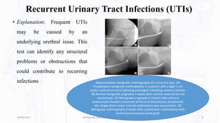 Recurrent Urinary Tract Infections (UTIs)
• Explanation: Frequent UTIs
may be caused by an
underlying urethral issue. This
test can identify any structural
problems or obstructions that
could contribute to recurring
infections Representative retrograde urethrography of a recurrent case. (A)
Preoperative retrograde urethrography in a patient with a tight 1-cm
bulbar urethral stricture following prolonged indwelling urethral catheter.
(B) Normal retrograde urography 2 weeks after excision and end-to-end
anastomosis. (C) Retrograde urography 4 months after primary
anastomosis showed a recurrent stricture at the previous anastomotic
site. Single direct-vision internal urethrotomy was unsuccessful. (D)
Retrograde urethrography 3 weeks after substitution urethroplasty with
ventral buccal mucosa onlay graft.
18/08/2023 Retrograde Urethrography By- Dr. Dheeraj Kumar 8
 