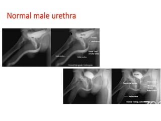Normal Retrograde Urethrogram Transverse retrograde urethrogram for urology residents | PPTX