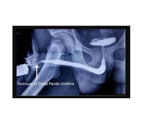 Steps Urethrogram retrograde urethrogram for urology residents | PPTX