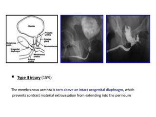 Steps Urethrogram retrograde urethrogram for urology residents | PPTX