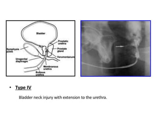 Retrograde Urethrogram Rupture retrograde urethrogram for urology residents | PPTX
